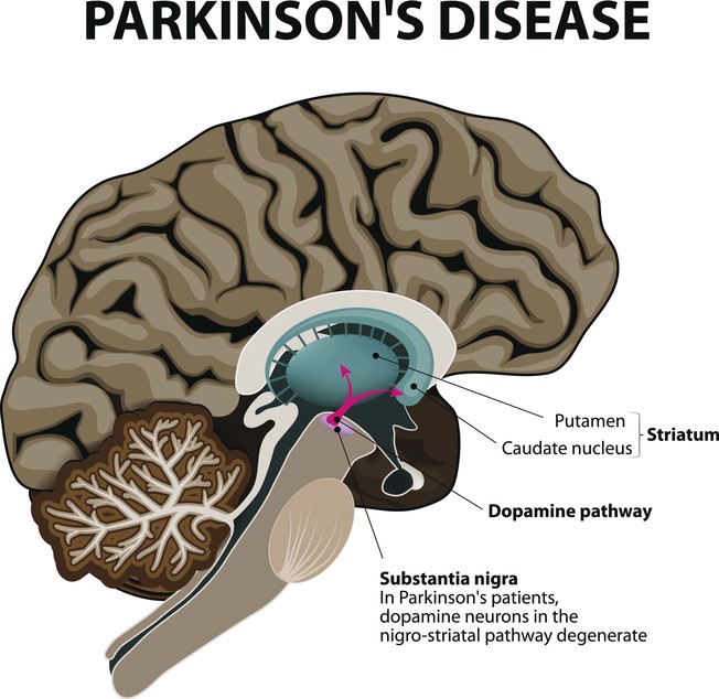 Desktop parkinson s disease