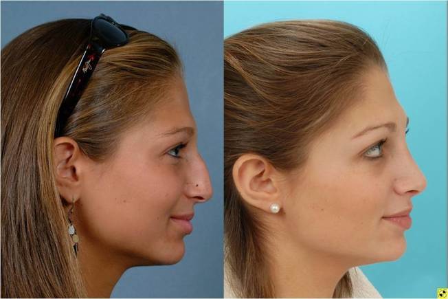 Desktop rhinoplasty